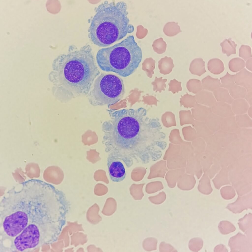 Mesothelial Lining Cell in Body Fluid