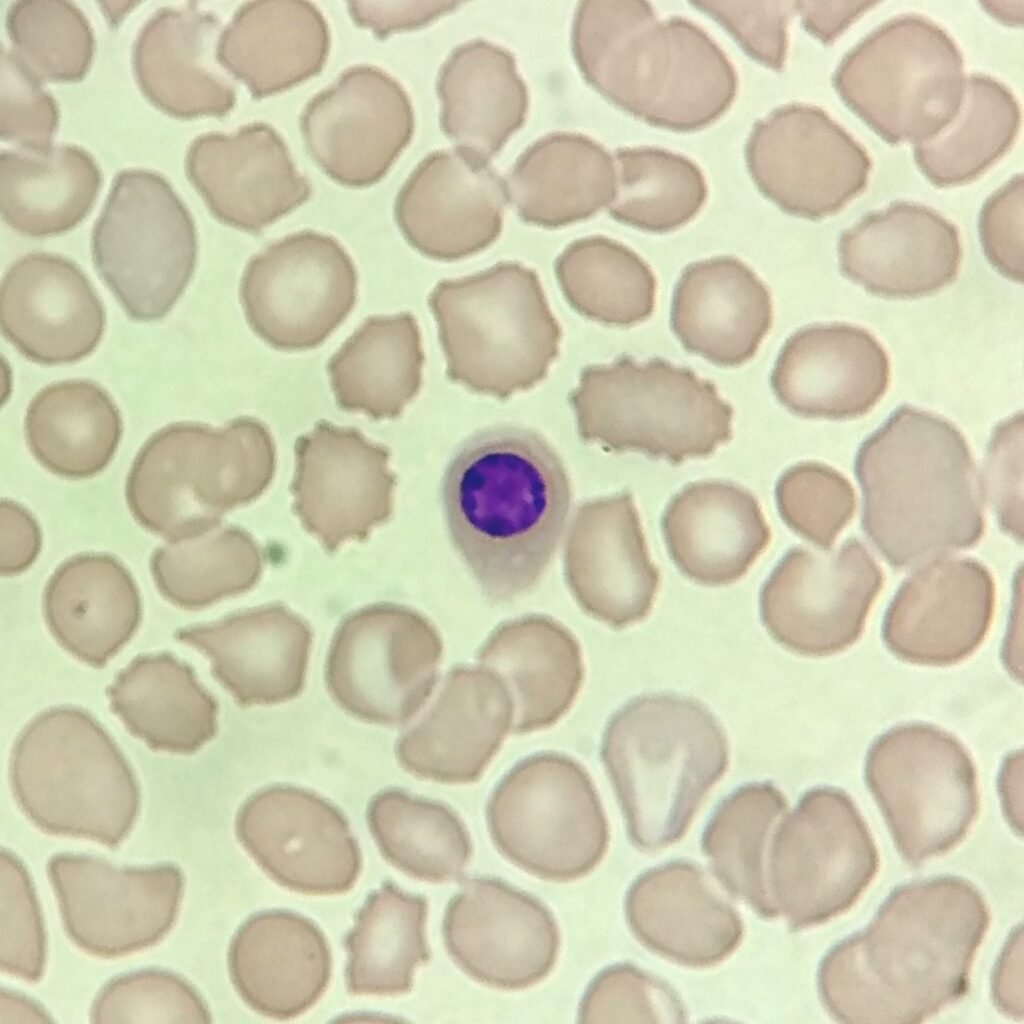A type of nucleated red blood cell: Orthochromatic Normoblast (Metarubricyte)