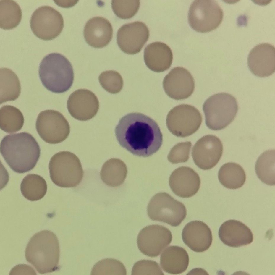 A type of nucleated red blood cell: Orthochromatic Normoblast (Metarubricyte)