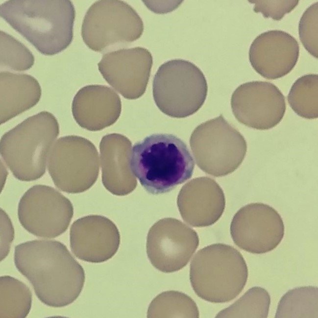 A type of nucleated red blood cell: Orthochromatic Normoblast (Metarubricyte)