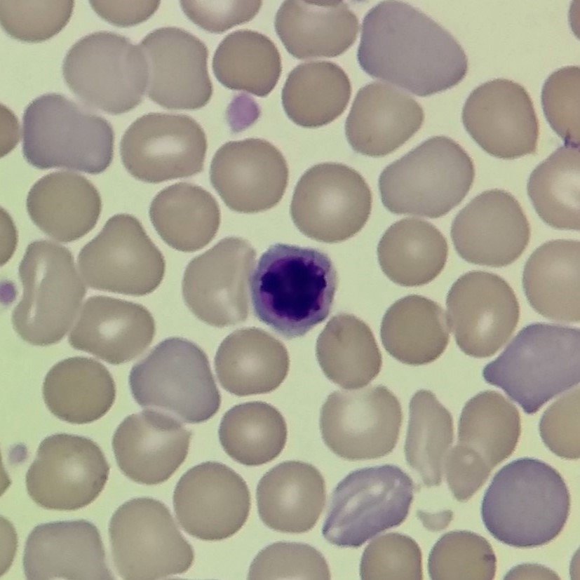 A type of nucleated red blood cell: Orthochromatic Normoblast (Metarubricyte)