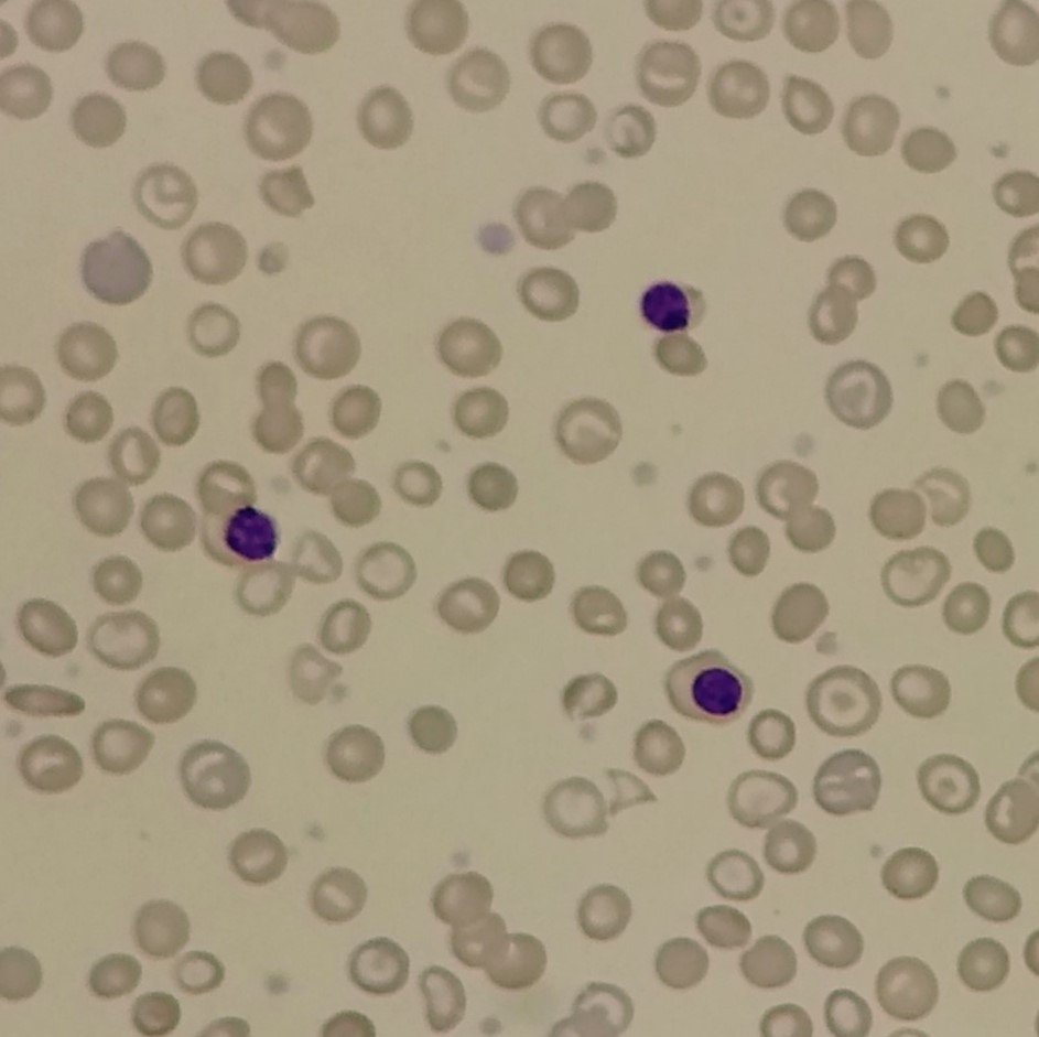 A type of nucleated red blood cell: Orthochromatic Normoblast (Metarubricyte)