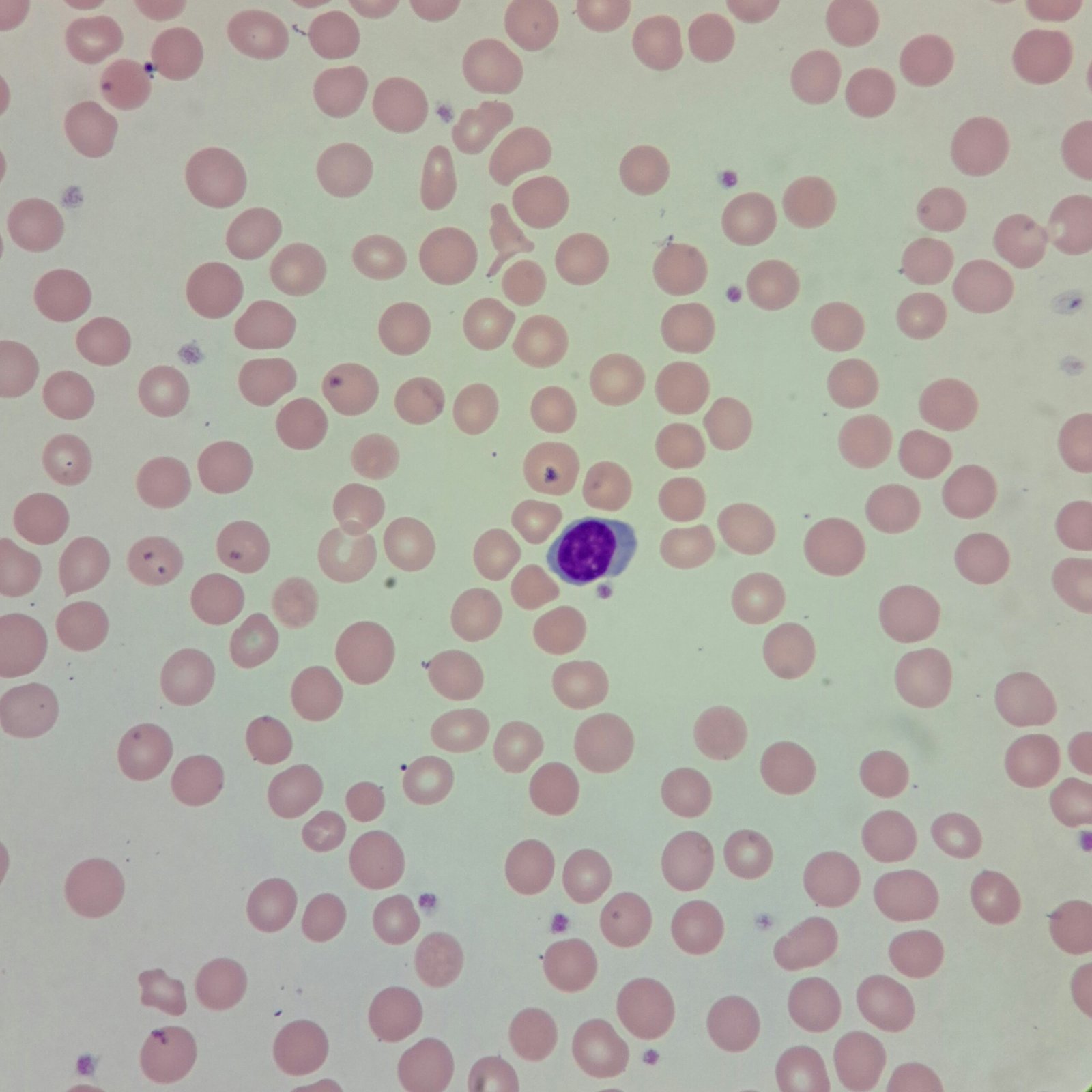Red Blood Cells with decreased mean cell volume, showing microcytosis. The RBCs are shown to be smaller than the nucleus of a small resting lymph.