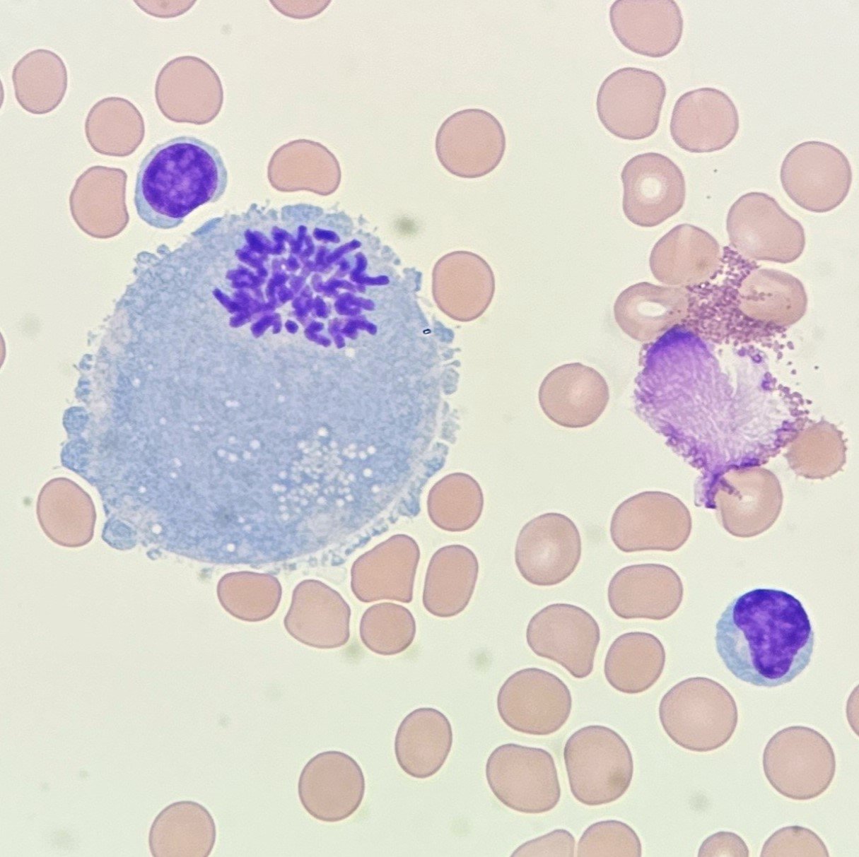 mitotic figure in body fluid