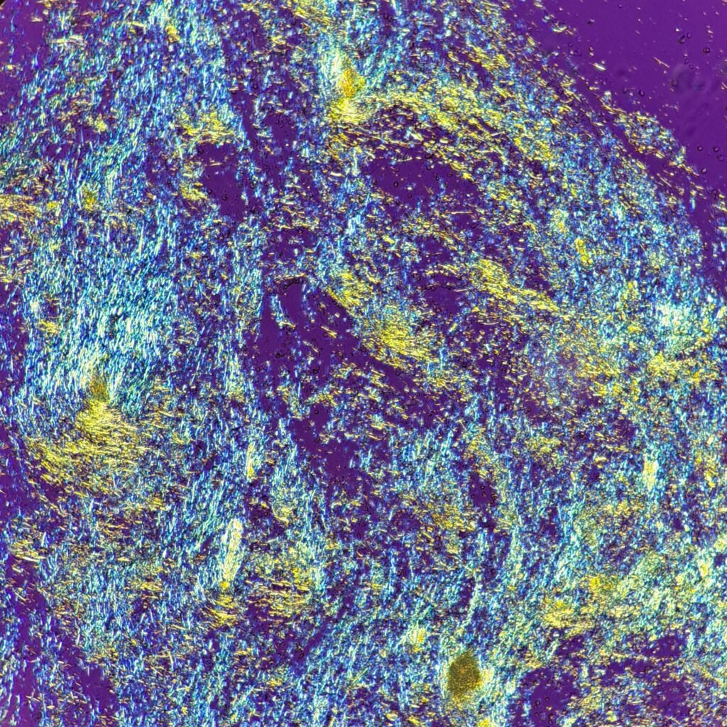 monosodium urate crystals (gout) in body fluid, polarized