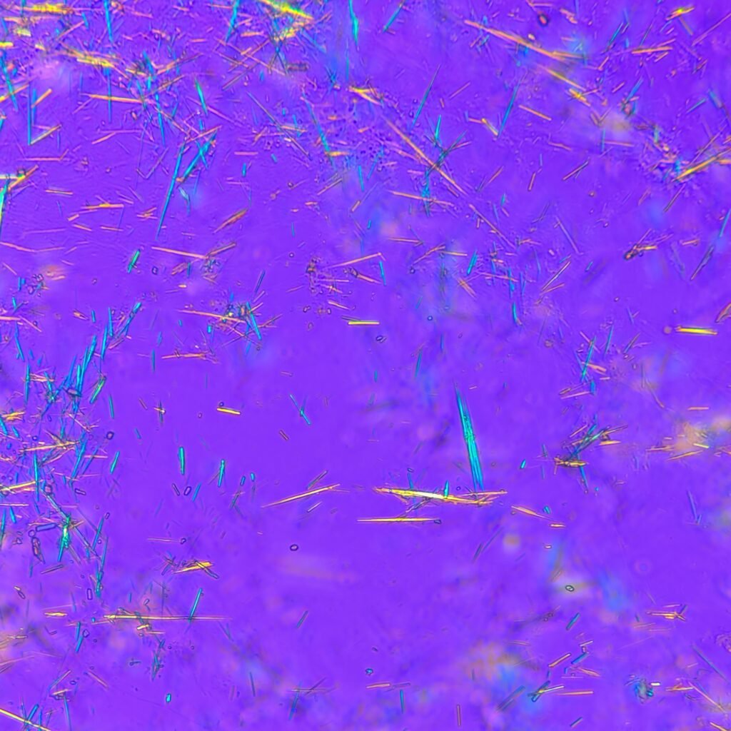 Monosodium Urate Crystals (Gout) in body fluid