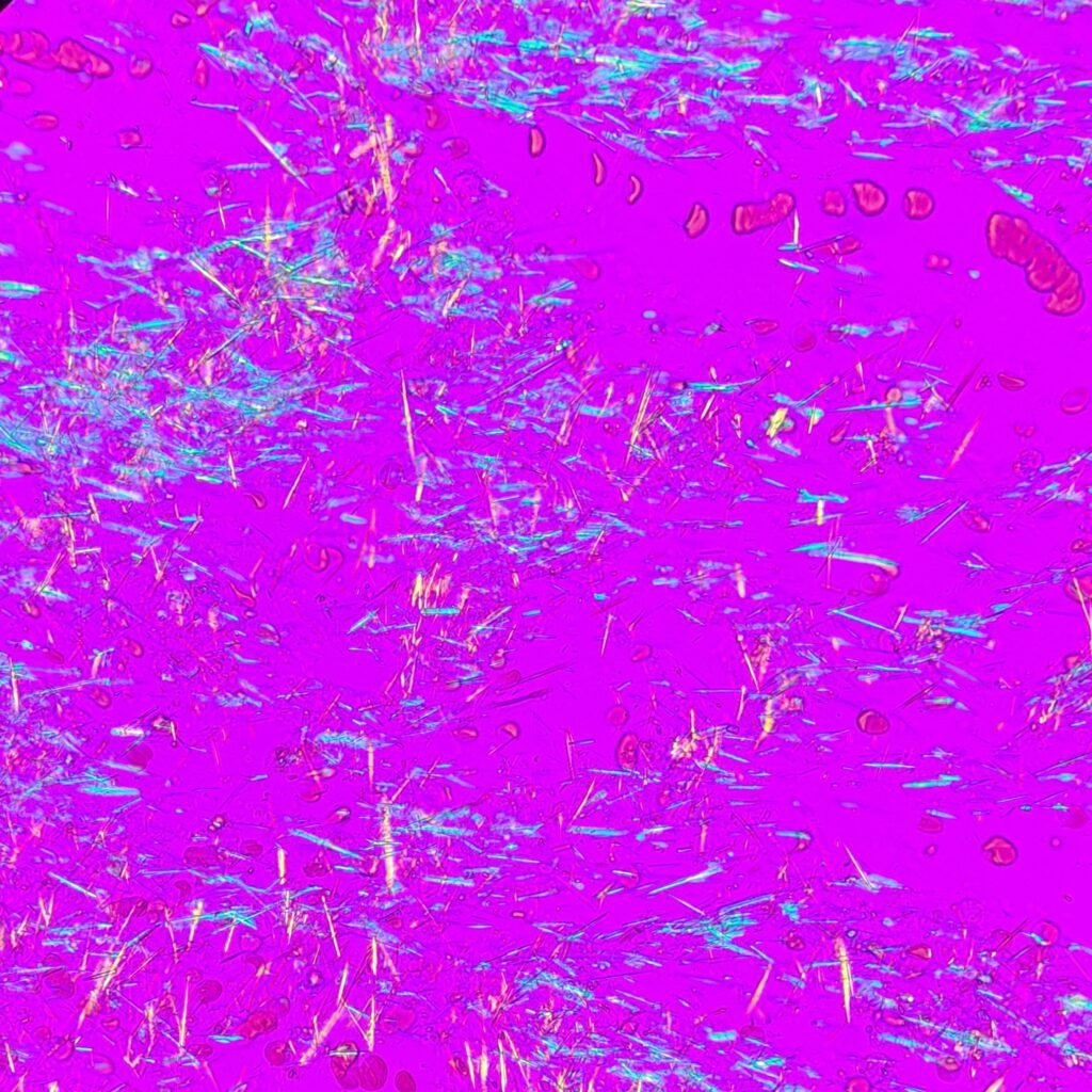 Monosodium Urate Crystals (Gout) in body fluid