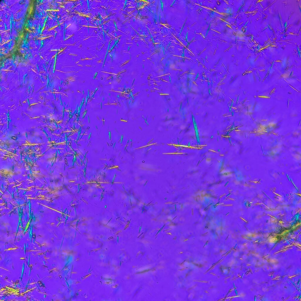 Monosodium Urate Crystals (Gout) in body fluid