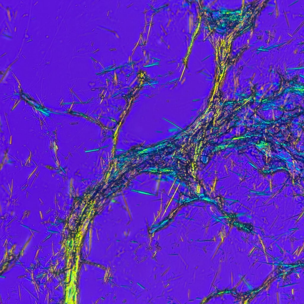 Monosodium Urate Crystals (Gout) in body fluid