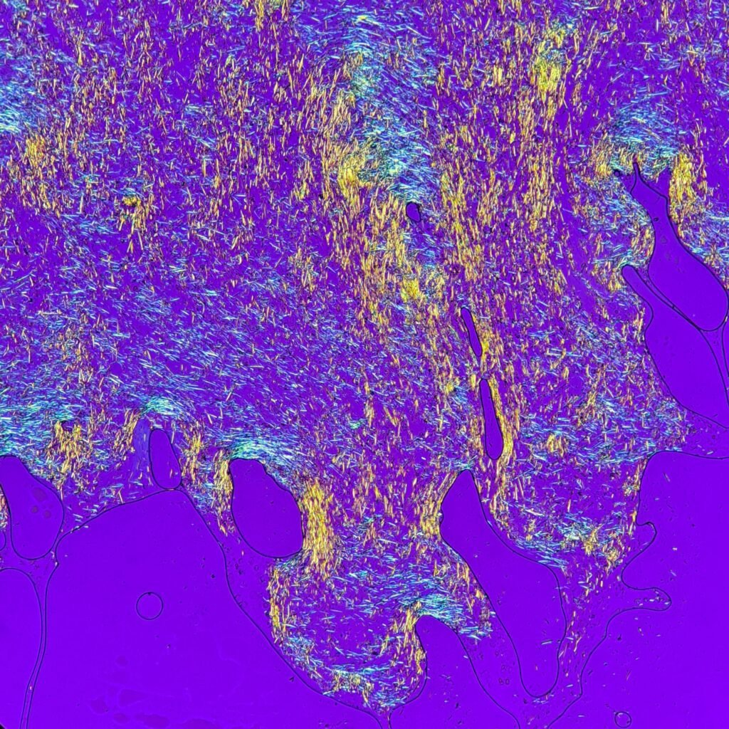 monosodium urate crystals (gout) in body fluid, polarized