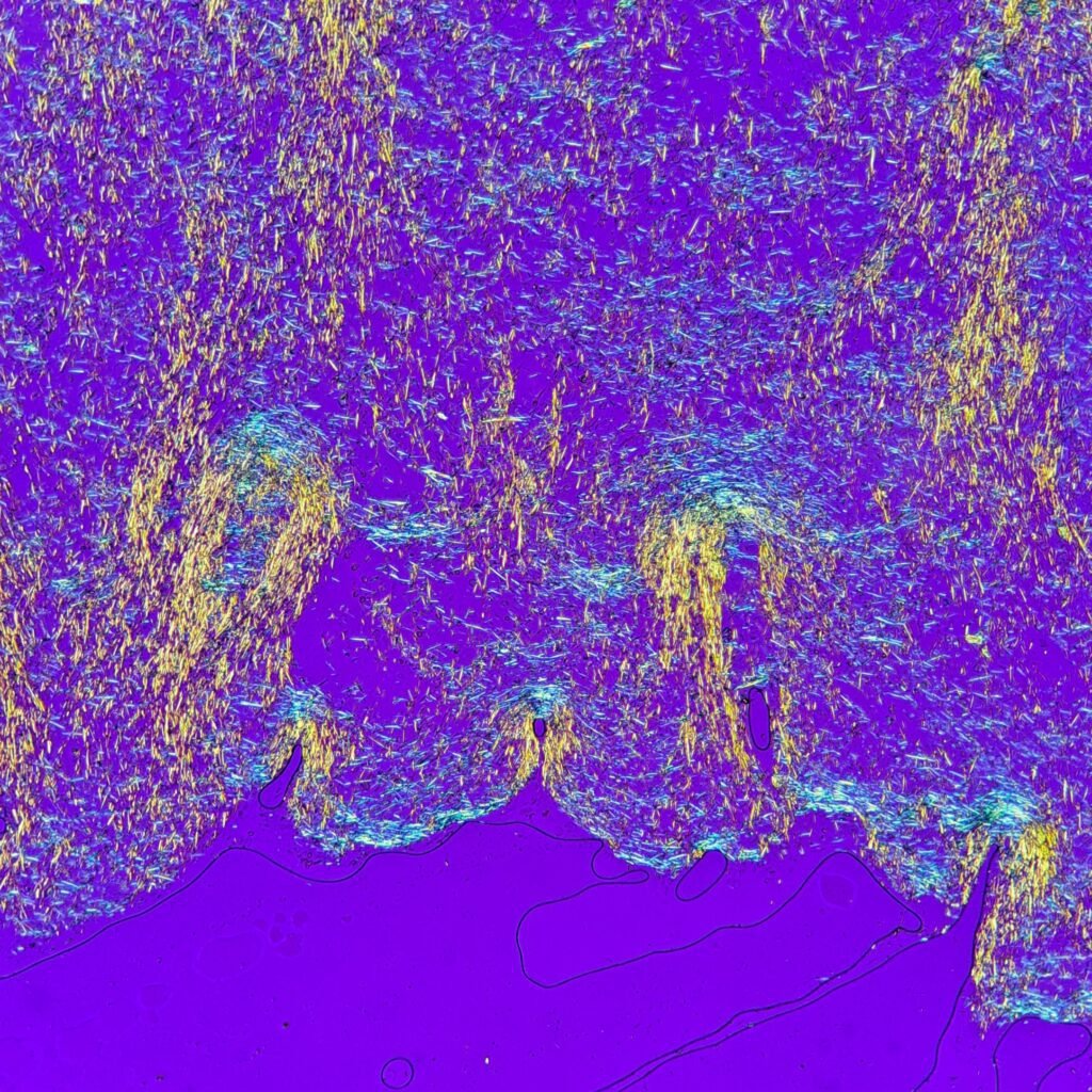 monosodium urate crystals (gout) in body fluid, polarized