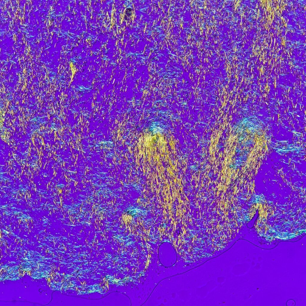monosodium urate crystals (gout) in body fluid, polarized
