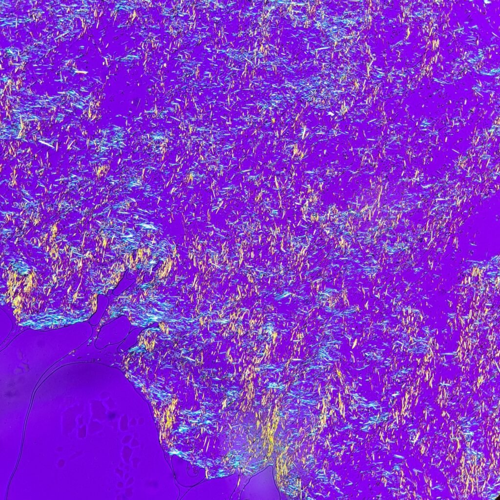 monosodium urate crystals (gout) in body fluid, polarized