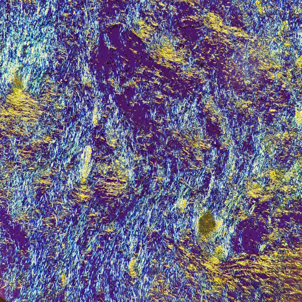 monosodium urate crystals (gout) in body fluid, polarized