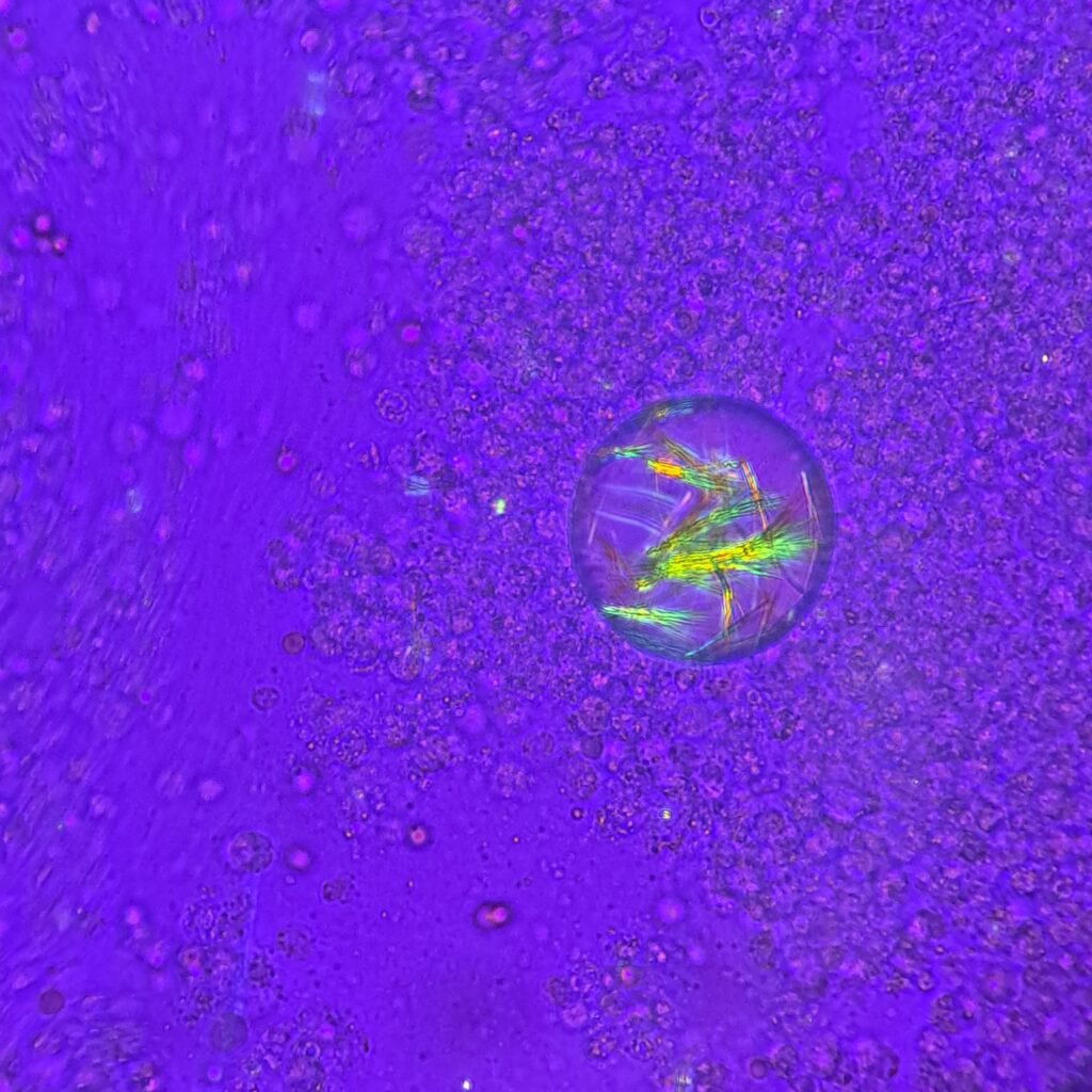 Monosodium Urate Crystals (Gout) in body fluid