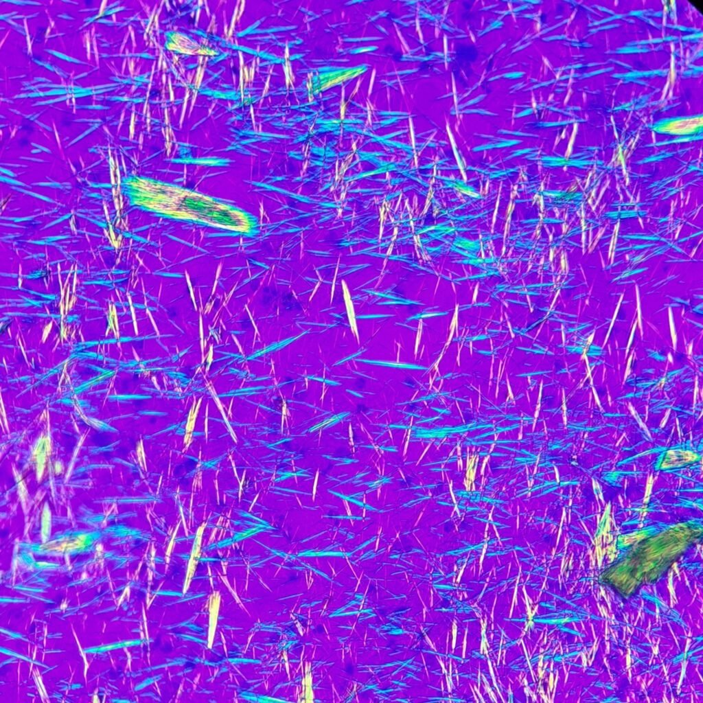 monosodium urate crystals (gout) in body fluid, polarized