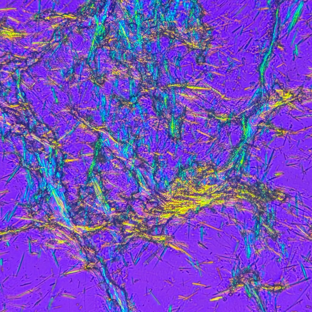 Monosodium Urate Crystals (Gout) in body fluid