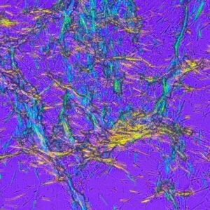 Body Fluid Crystals: Identification and Clinical Significance