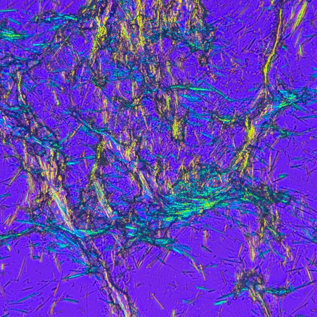 Monosodium Urate Crystals (Gout) in body fluid