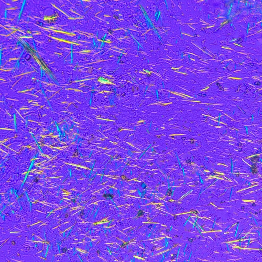 Monosodium Urate Crystals (Gout) in body fluid