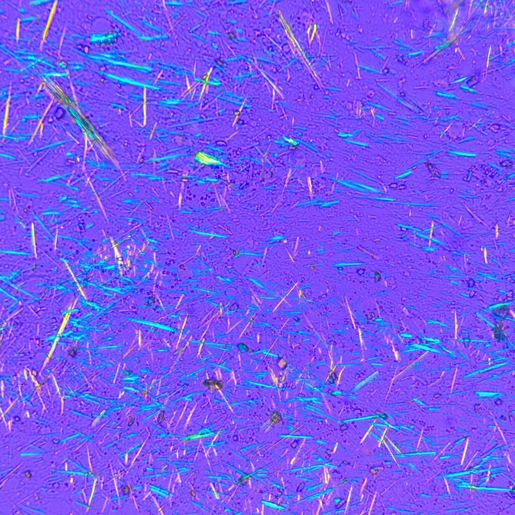 Monosodium Urate Crystals (Gout) in body fluid