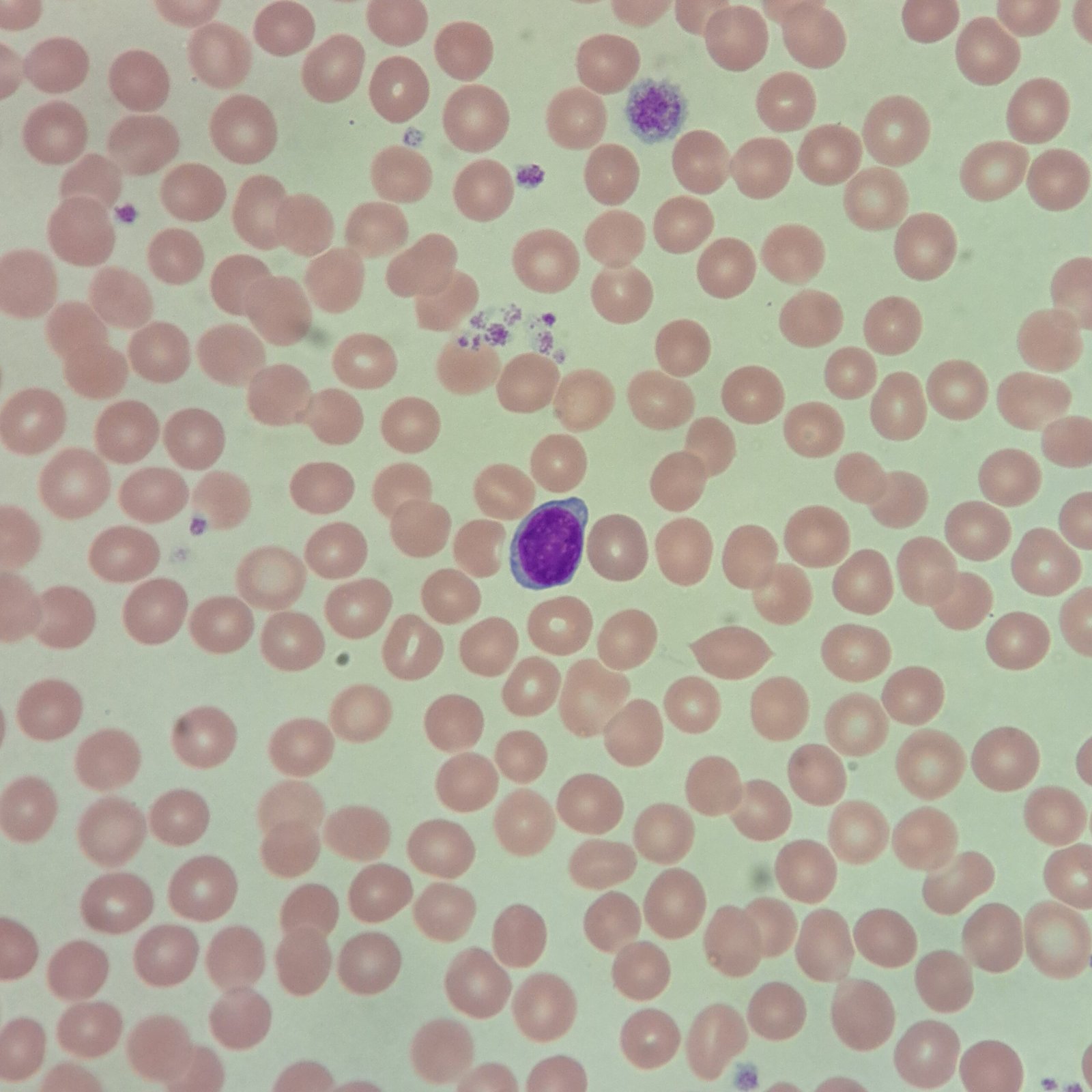 Normocytic Normochromic red blood cells with lymphocyte for comparison