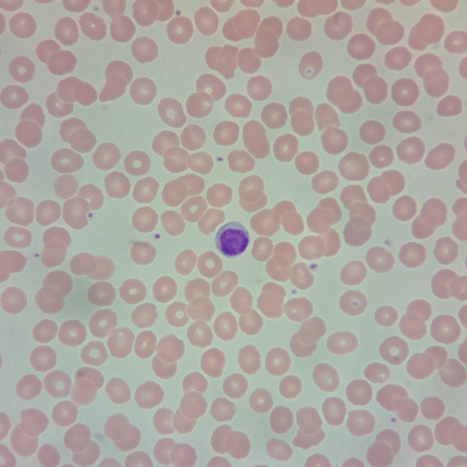 RBC Morphology Based on Indices