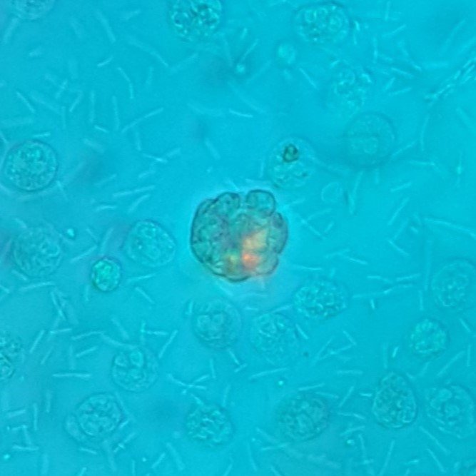 oval fat bodies in urine, polarized. Fat droplets show Maltese cross pattern
