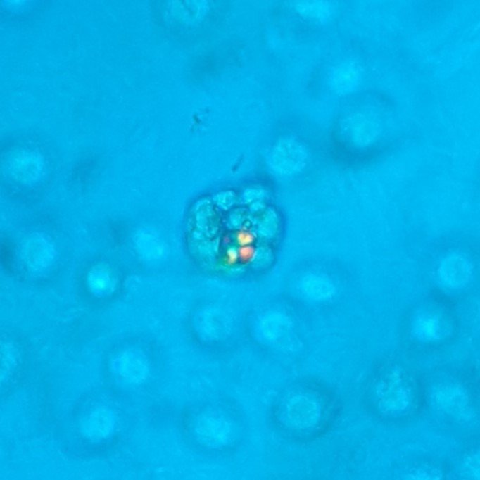 oval fat bodies in urine, polarized. Fat droplets show Maltese cross pattern