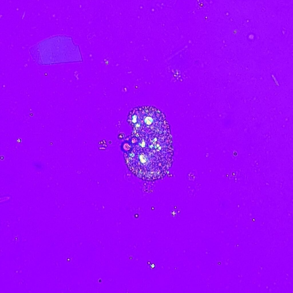 oval fat bodies in urine, polarized. Fat droplets show Maltese cross pattern