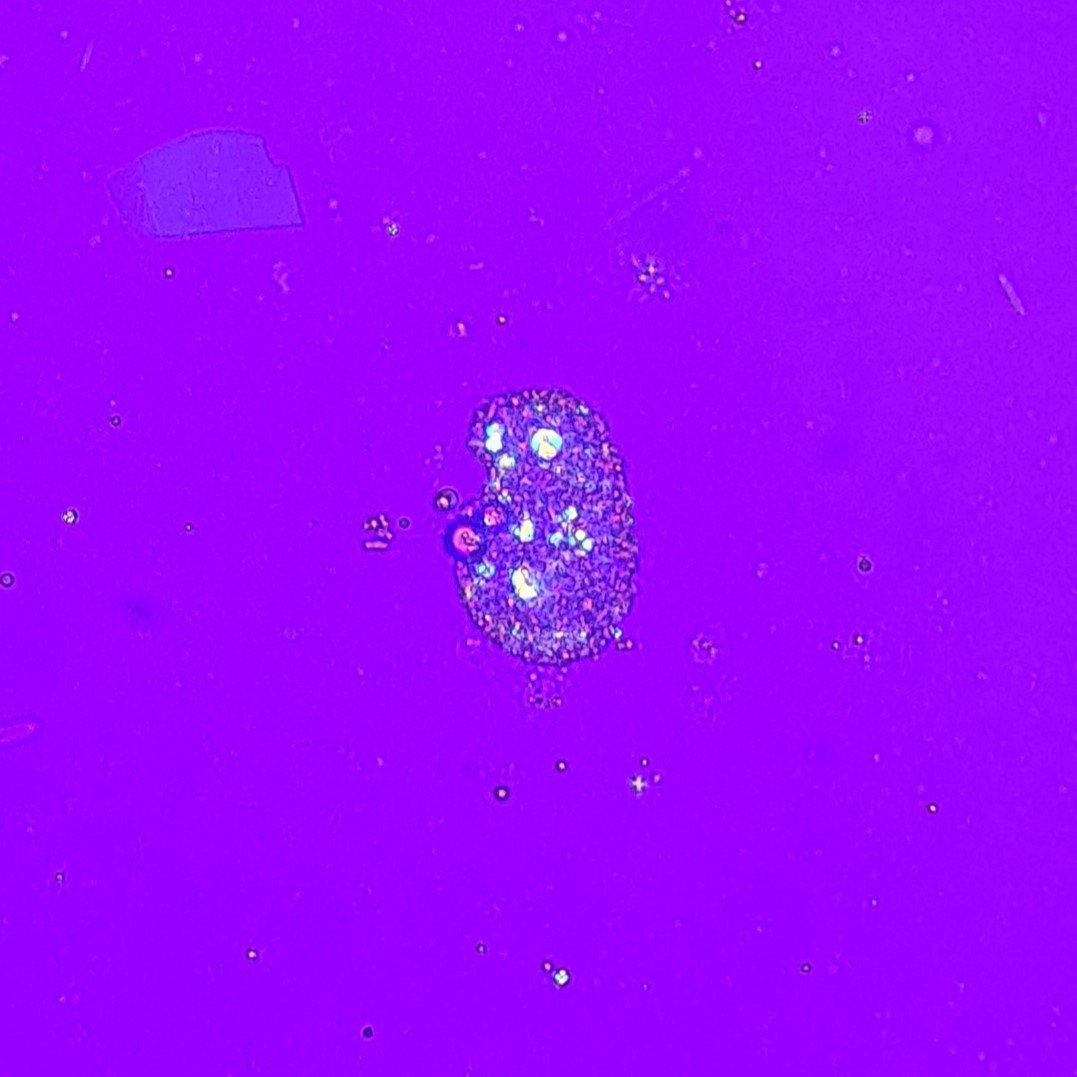 Oval Fat Body in Urine, Polarized. Maltese Crosses can be seen
