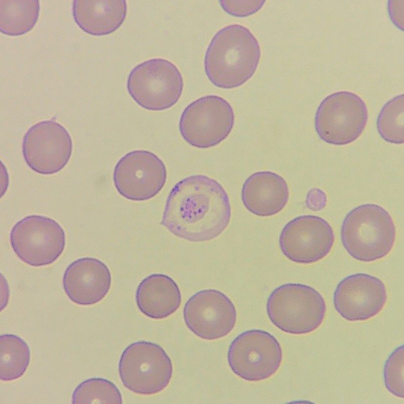 Pappenheimer Bodies in RBCs