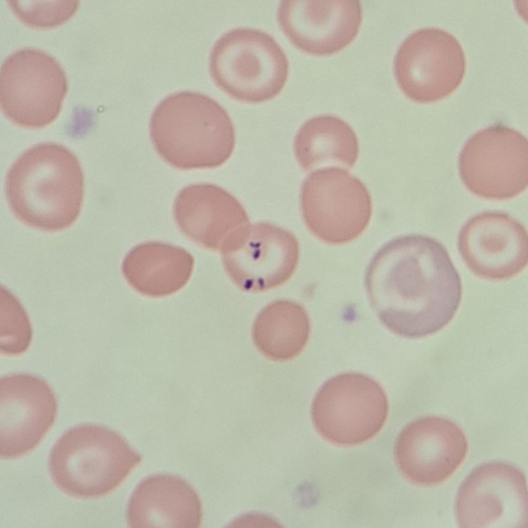 Pappenheimer bodies, red blood cell inclusion