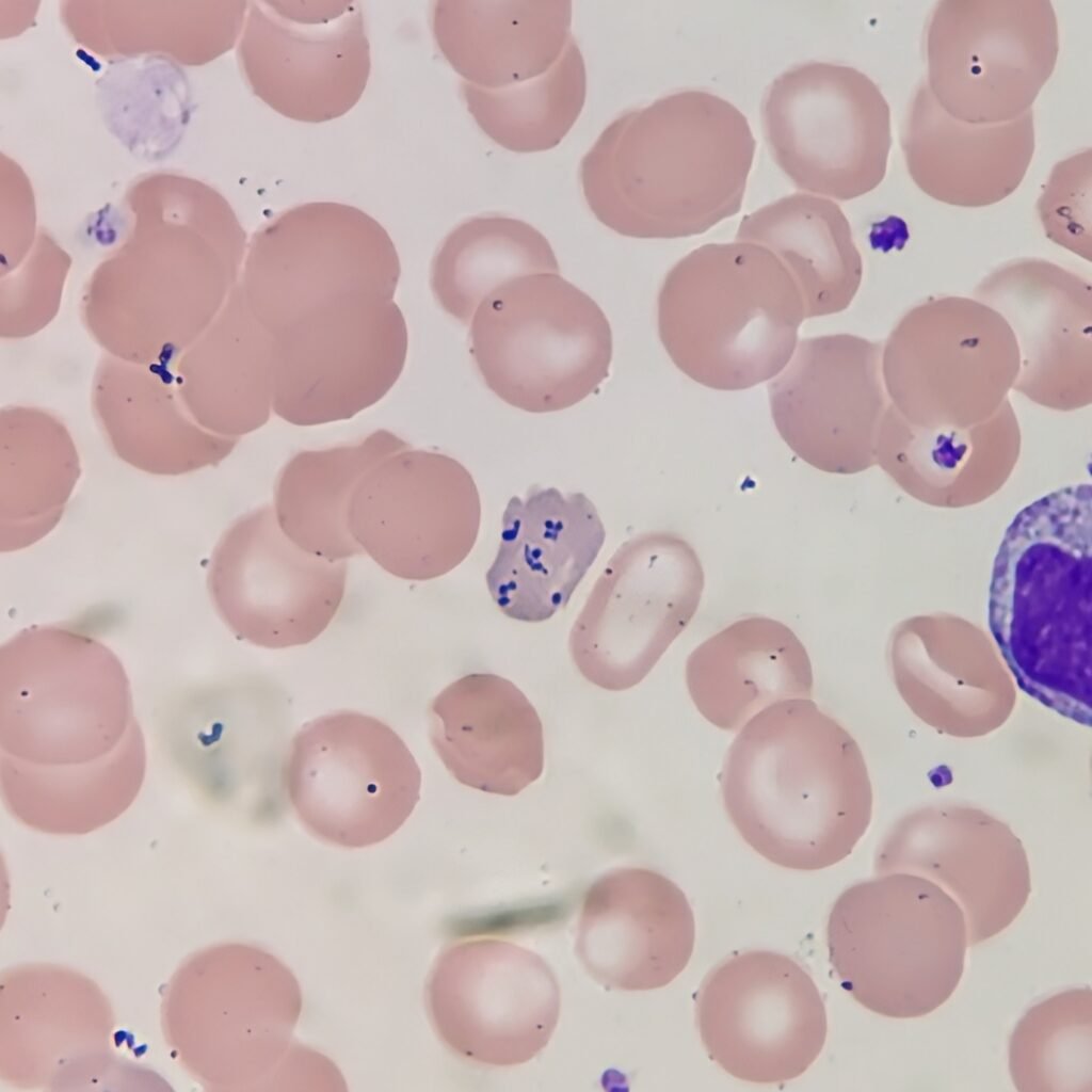 Pappenheimer bodies, red blood cell inclusion