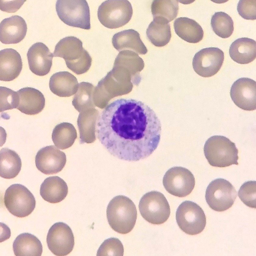 Pelgeroid, Monolobated Neutrophil
