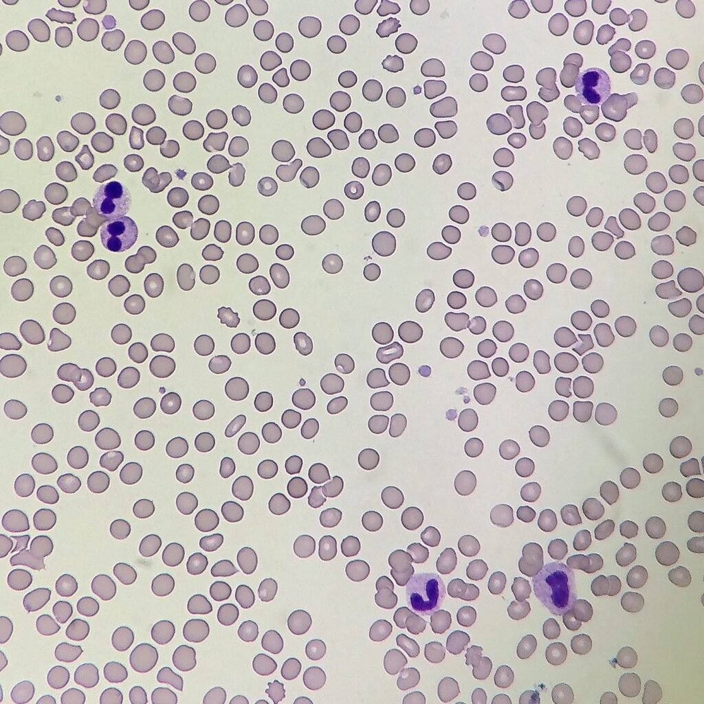 Pelger-Huet Anomaly in neutrophil