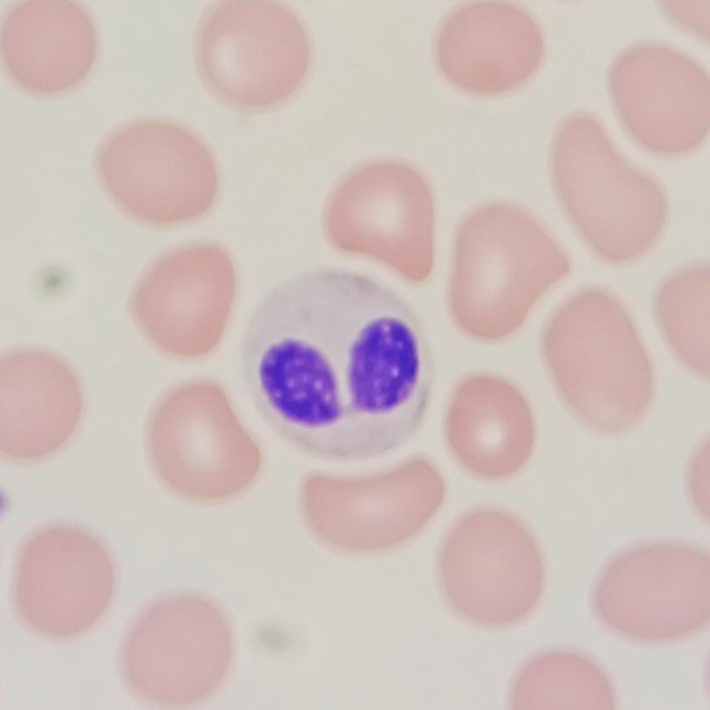Pelger-Huet Anomaly in neutrophil