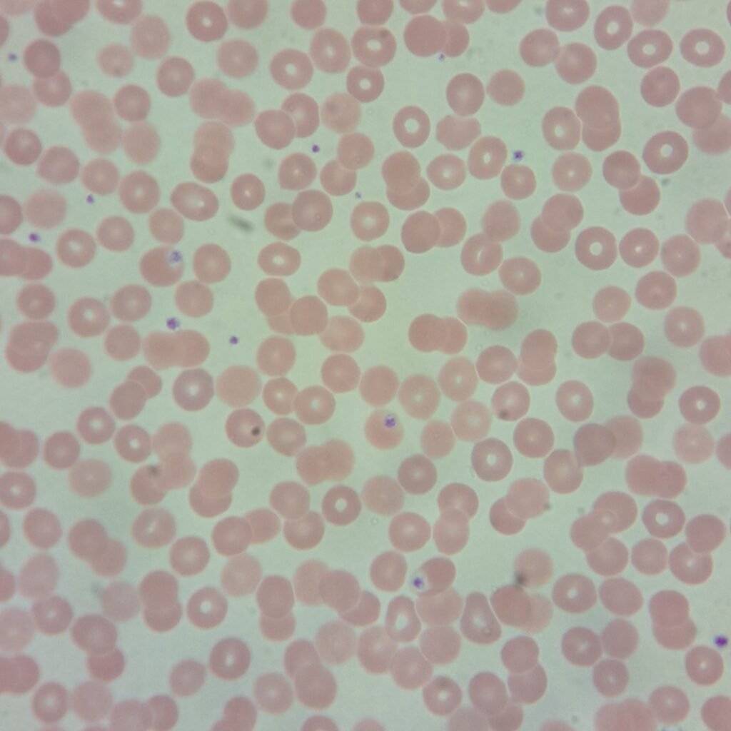 Malaria - MedLabBuddy