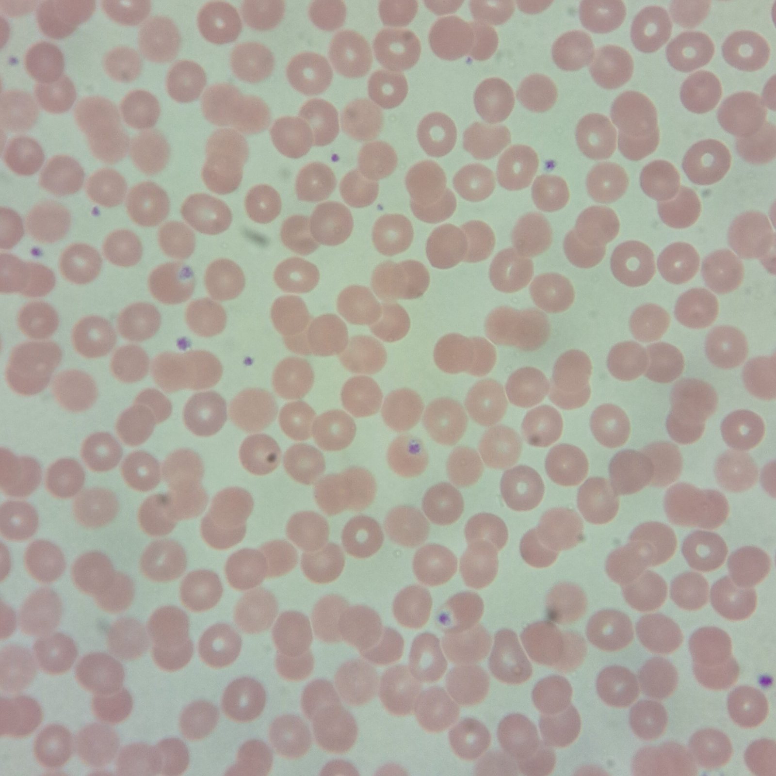 overlying platelet on red blood cell