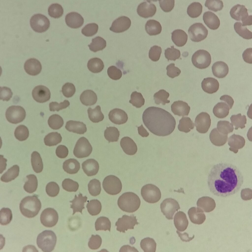 Polychromatophilic Morphology, RBCs with Polychromasia
