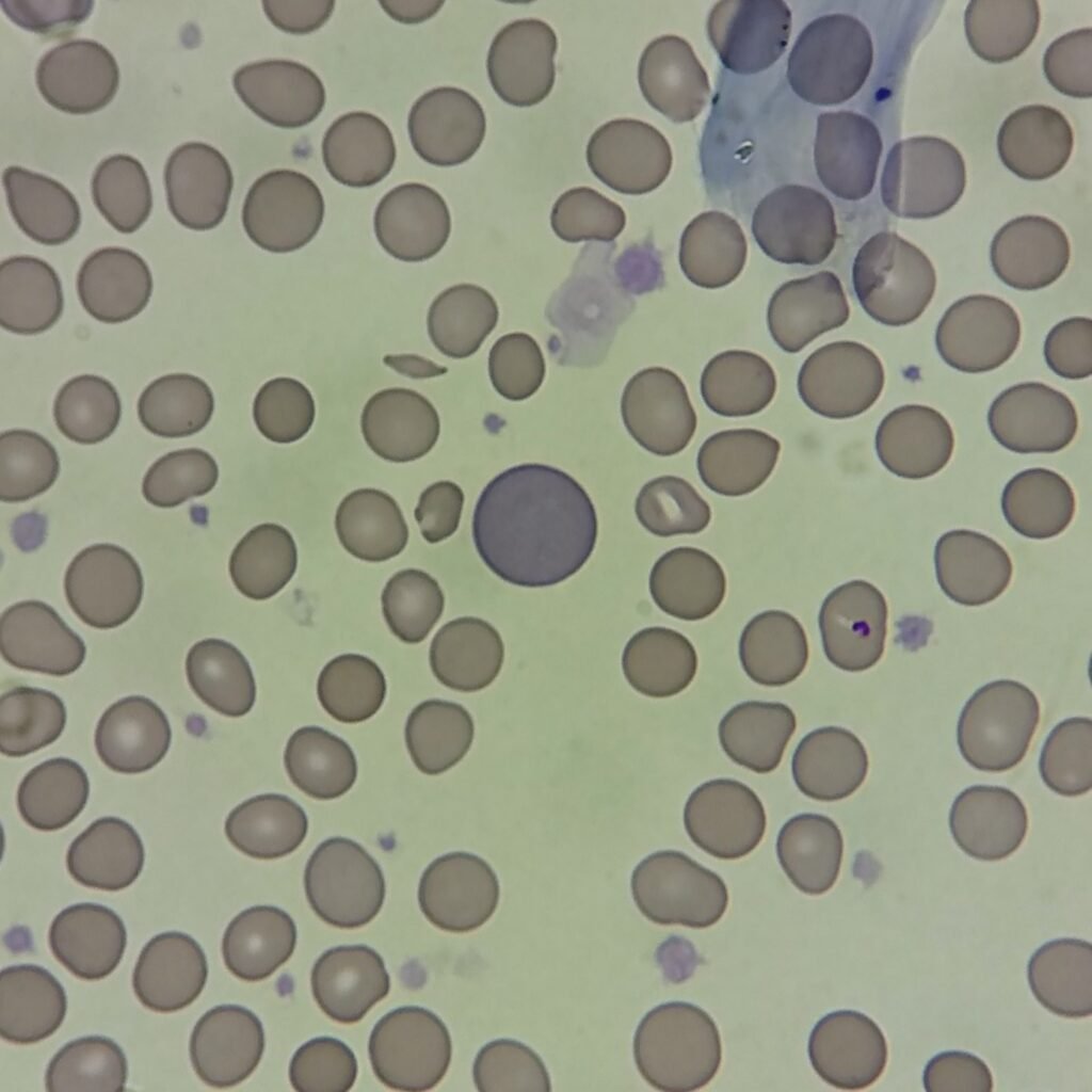Polychromatophilic Morphology, RBCs with Polychromasia