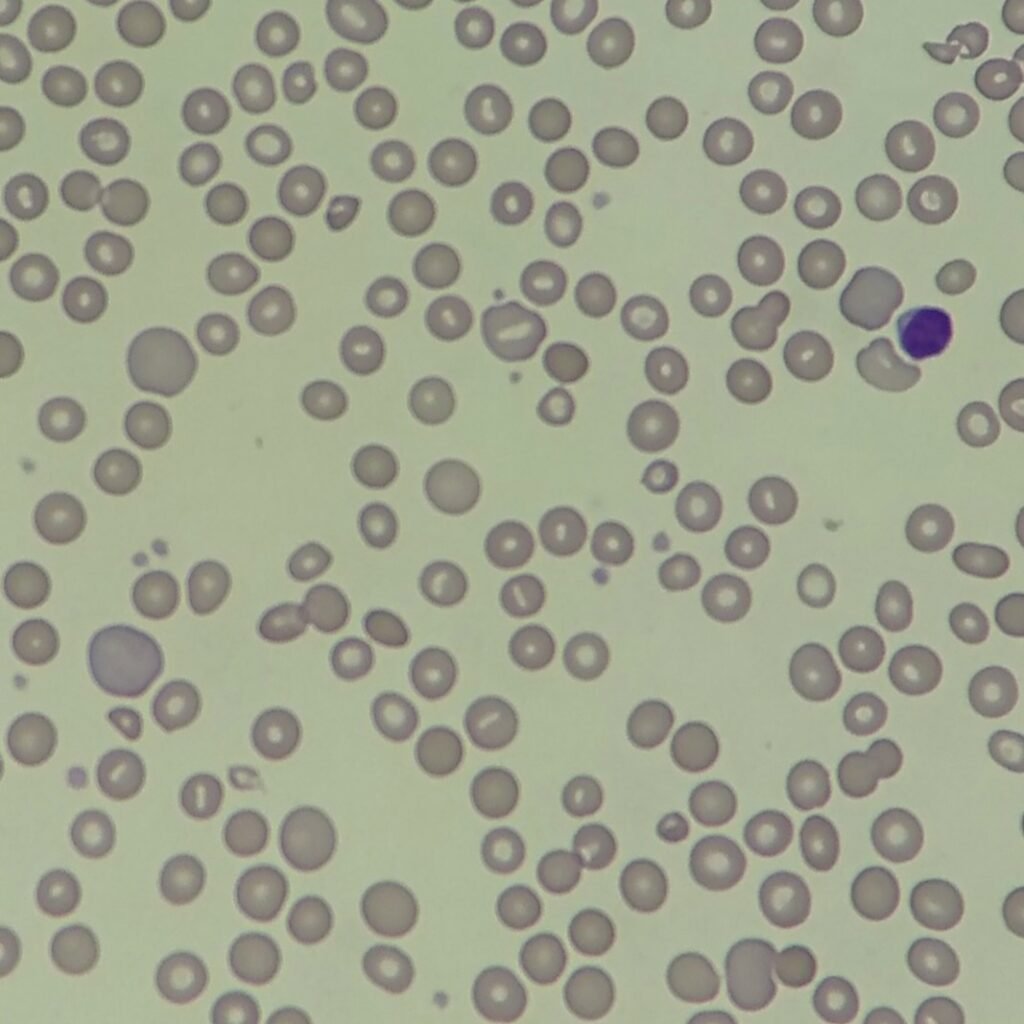 Polychromatophilic Morphology, RBCs with Polychromasia