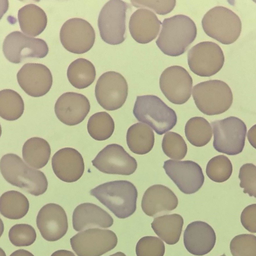 Polychromatophilic Morphology, RBCs with Polychromasia