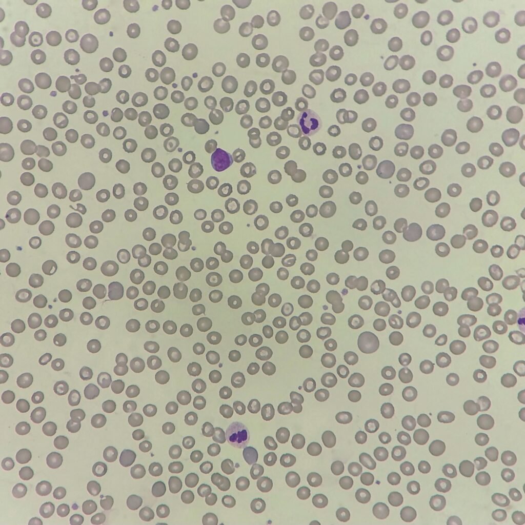 Polychromatophilic Morphology, RBCs with Polychromasia