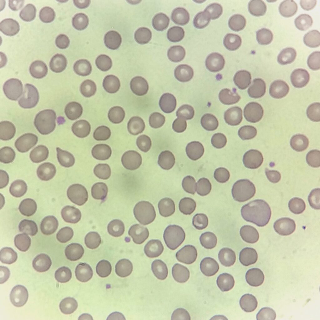 Polychromatophilic Morphology, RBCs with Polychromasia