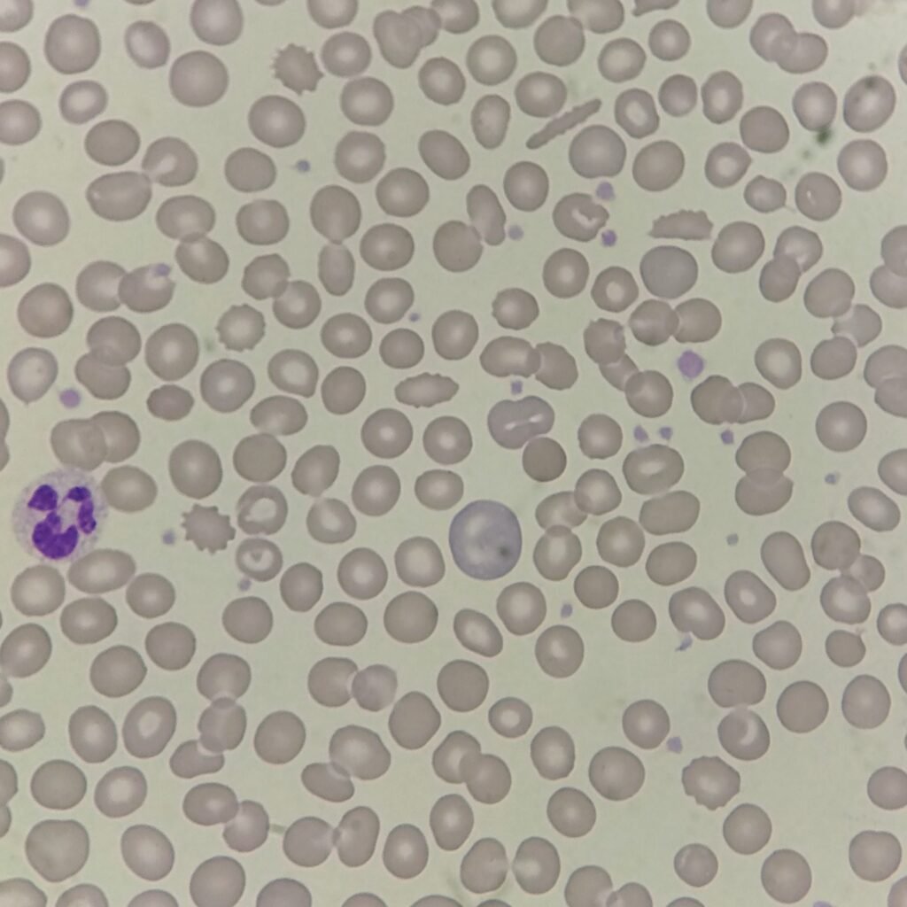 Polychromatophilic Morphology, RBCs with Polychromasia