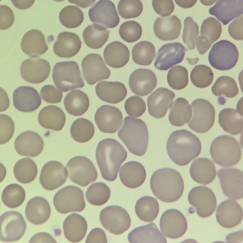 Polychromatophilic Morphology, RBCs with Polychromasia