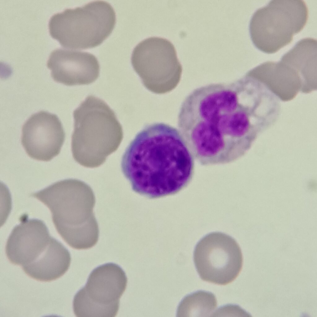 A type of nucleated red blood cell: Basophilic Normoblast (Prorubricyte)