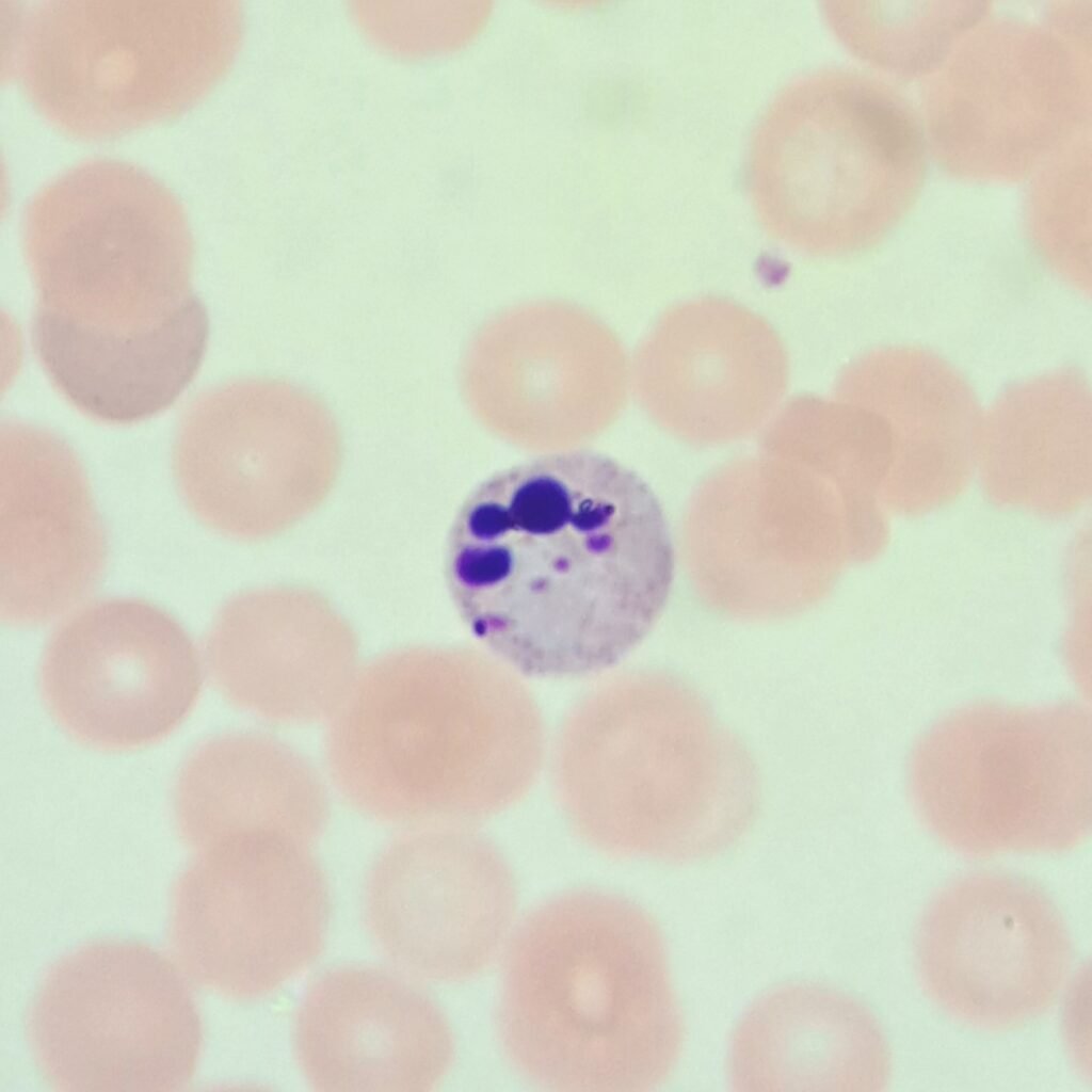 pyknotic neutrophil