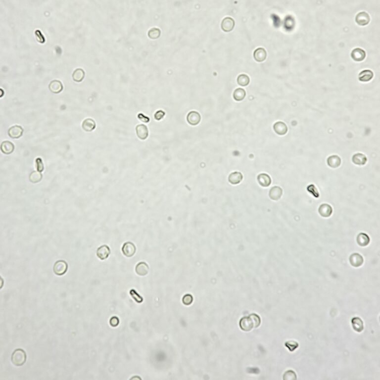 Gecko Rbcs RBCs in Urine & Their Lookalikes - MedLabBuddy